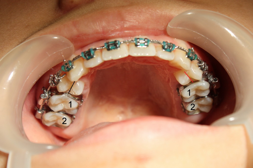 How Long Does It Take For Teeth To Shift After Extraction With Braces How To Take Out A Tooth